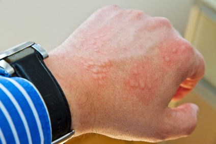 Woran erkennt man eine Waschmittelallergie? Ursachen, Symptome, Behandlung und Alternativen